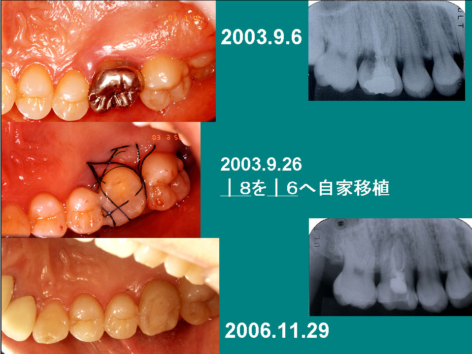№８８「昔の名前で出ています」自家歯牙移植の臨床